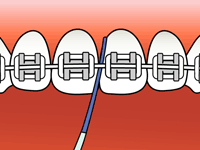 flossing diagram