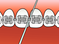 flossing diagram