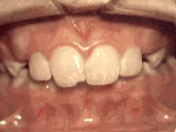 overbite before